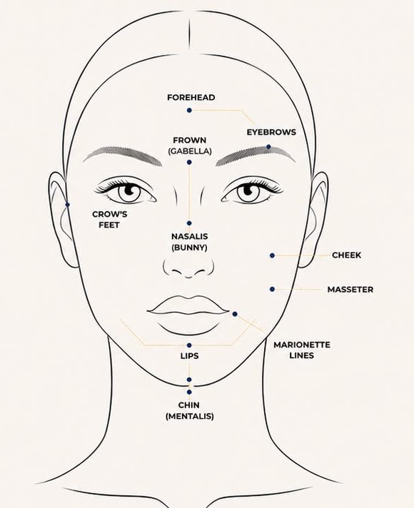Illustrated face map marking common treatment areas: forehead, frown, eyebrows, crow's feet, nasalis, cheek, masseter, marionette lines, lips and chin